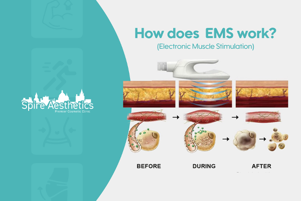 EMS treatment for post pregnancy weight loss treatment Glossop