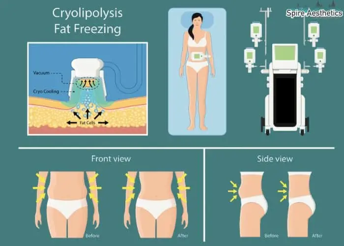 Fat freezing treatment Glossop benefits for competitions to remove stubborn fat deposits.