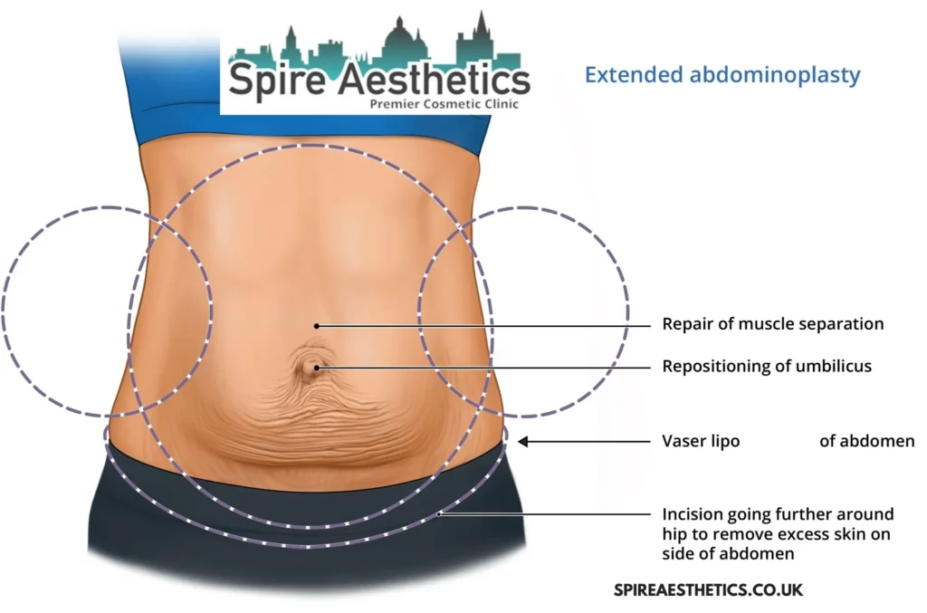 Understanding Loose Skin After Gastric Band Glossop Surgery and HIFU Treatment