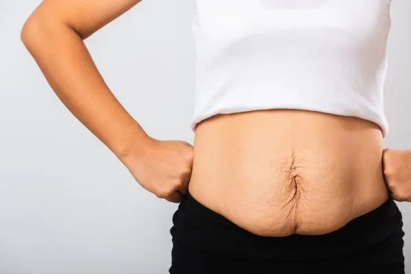 Image of a woman's stomach after weight loss with sagging skin following a gastric band Glossop