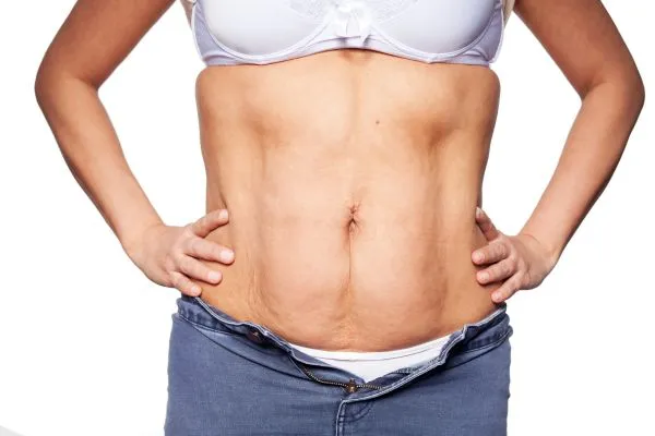 sagging skin on woman's stomach after weight loss injections Glossop