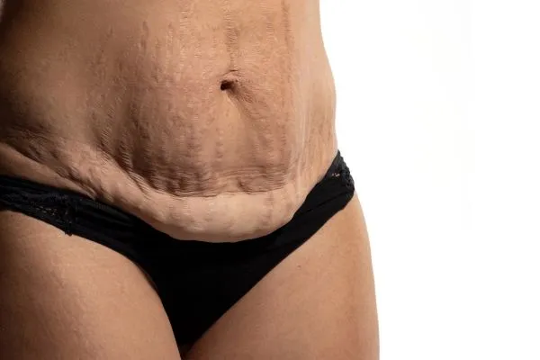 Image of womans stomach after weight loss injections Glossop showing saggy skin